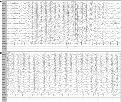 Novel Truncating and Missense Variants in SEMA6B in Patients With Early-Onset Epilepsy